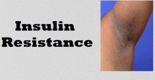 Insulin Resisitance skin manifestation: acanthosis nigricans